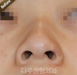 Rhinoplasty