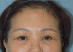 face lift