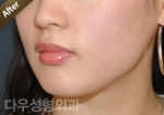 facial contouring