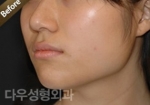 facial contouring