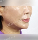 face lift