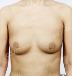 breast