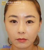 face lift