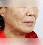 face lift
