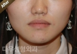 facial contouring