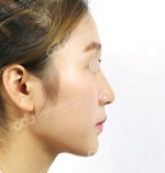 face lift