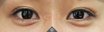 Glovi Plastic Surgery, Reviews, Images, Promotions, Dr. Rho Bongil, Dr. Nam Sangjae, Dr. Park Jongchul — Korea cost, reviews & before-after | MISOODA