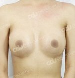 breast