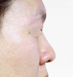 Rhinoplasty