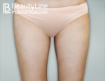 Beauty Line Plastic Surgery,Reviews,Images, Promotions — Korea cost, reviews & before-after | MISOODA