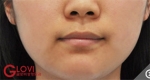 Glovi Plastic Surgery, Reviews, Images, Promotions, Dr. Rho Bongil, Dr. Nam Sangjae, Dr. Park Jongchul — Korea cost, reviews & before-after | MISOODA