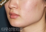 facial contouring