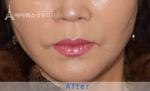 face lift