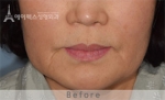 face lift