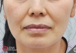 Glovi Plastic Surgery, Reviews, Images, Promotions, Dr. Rho Bongil, Dr. Nam Sangjae, Dr. Park Jongchul — Korea cost, reviews & before-after | MISOODA