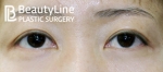 Beauty Line Plastic Surgery,Reviews,Images, Promotions — Korea cost, reviews & before-after | MISOODA