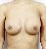 breast