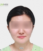 GYALUMHAN Plastic Surgery,Reviews,Images, Promotions — Korea cost, reviews & before-after | MISOODA