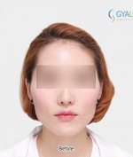 GYALUMHAN Plastic Surgery,Reviews,Images, Promotions — Korea cost, reviews & before-after | MISOODA