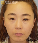face lift