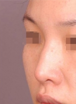 NJH Plastic Surgery,Reviews,Images, Promotions — Korea cost, reviews & before-after | MISOODA