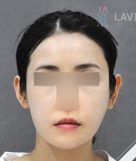face lift