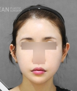 face lift