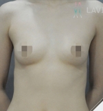 breast