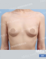 breast