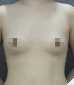 breast