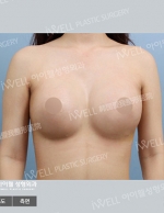 breast