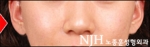 NJH Plastic Surgery,Reviews,Images, Promotions — Korea cost, reviews & before-after | MISOODA