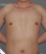 breast