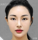 facial contouring