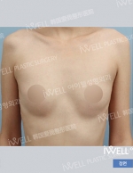 breast