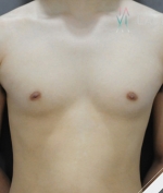breast