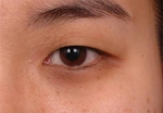 NJH Plastic Surgery,Reviews,Images, Promotions — Korea cost, reviews & before-after | MISOODA
