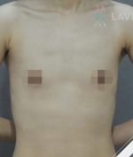 breast