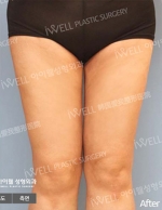 Liposuction