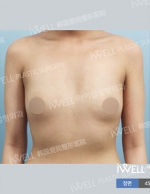 breast