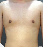 breast