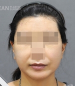 face lift
