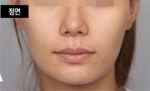 NJH Plastic Surgery,Reviews,Images, Promotions — Korea cost, reviews & before-after | MISOODA
