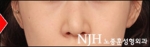 NJH Plastic Surgery,Reviews,Images, Promotions — Korea cost, reviews & before-after | MISOODA