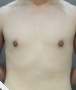breast