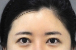 face lift