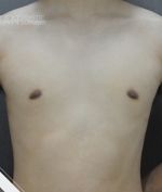 breast