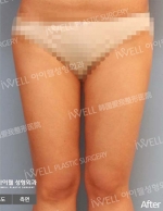Liposuction