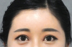 face lift