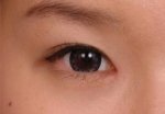 NJH Plastic Surgery,Reviews,Images, Promotions — Korea cost, reviews & before-after | MISOODA